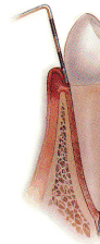 entzündetes Zahnfleisch entzündetes Zahnfleisch