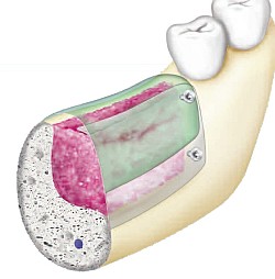 Knochenaufbau mit SonicWeld Rx®